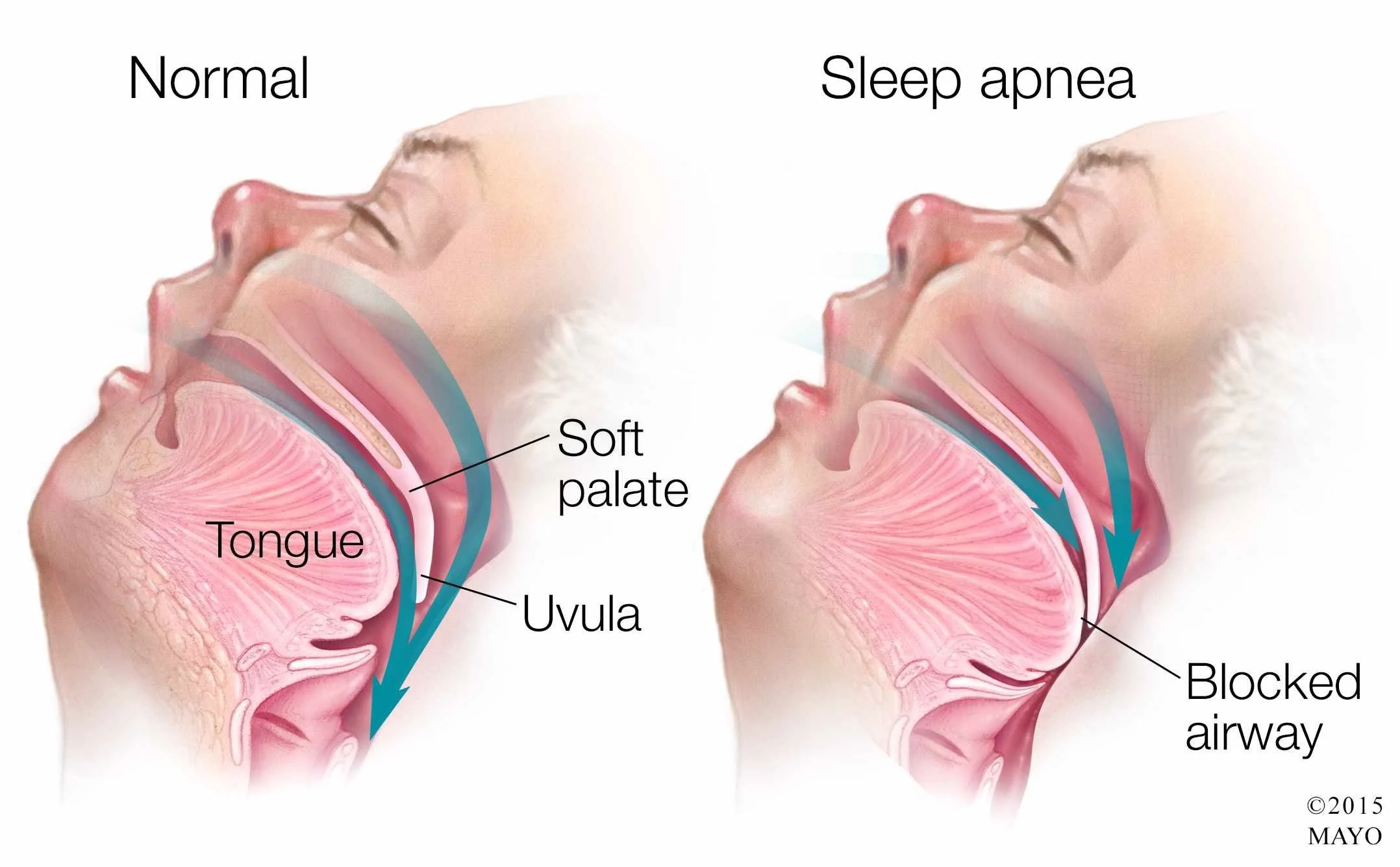 TMJ and Sleep Apnea
