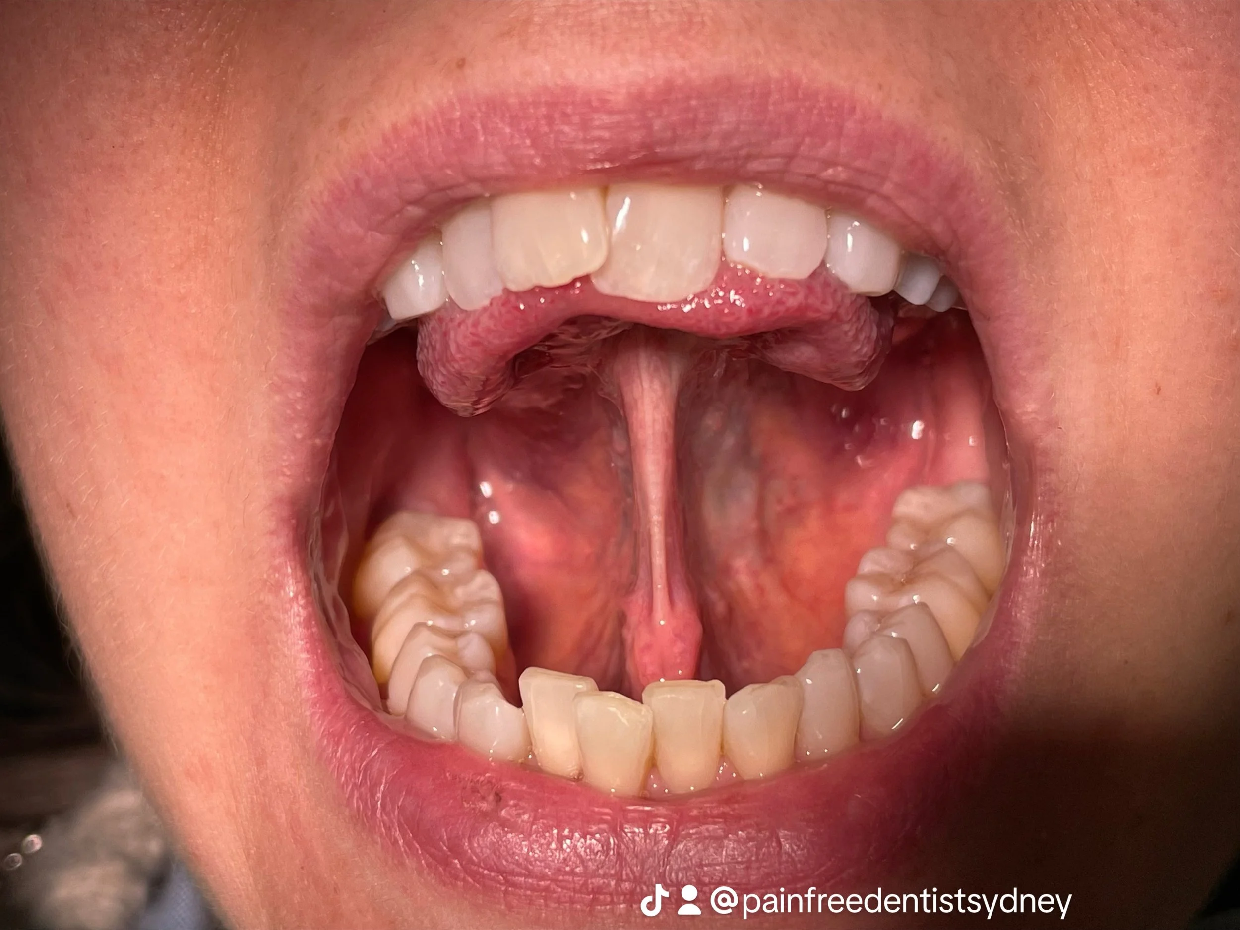 Tongue Tie Release and Palate Expansion: Enhancing Health Through Improved Oral Function