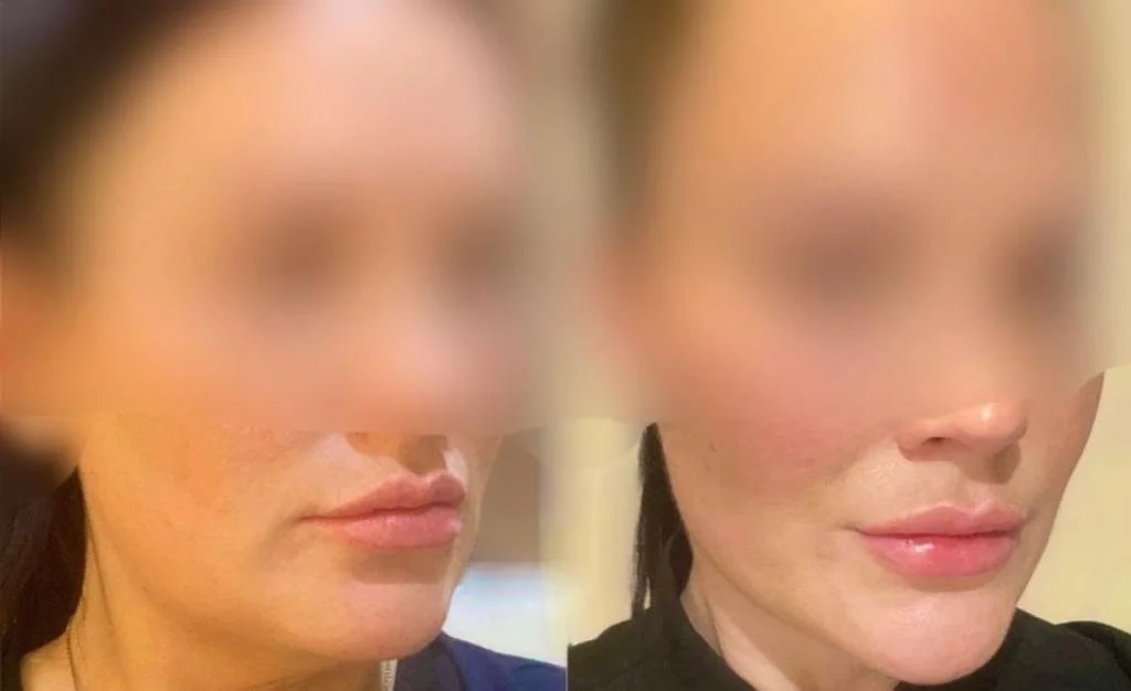 Anti-aging Facial rejuvenation  Jowl reduction