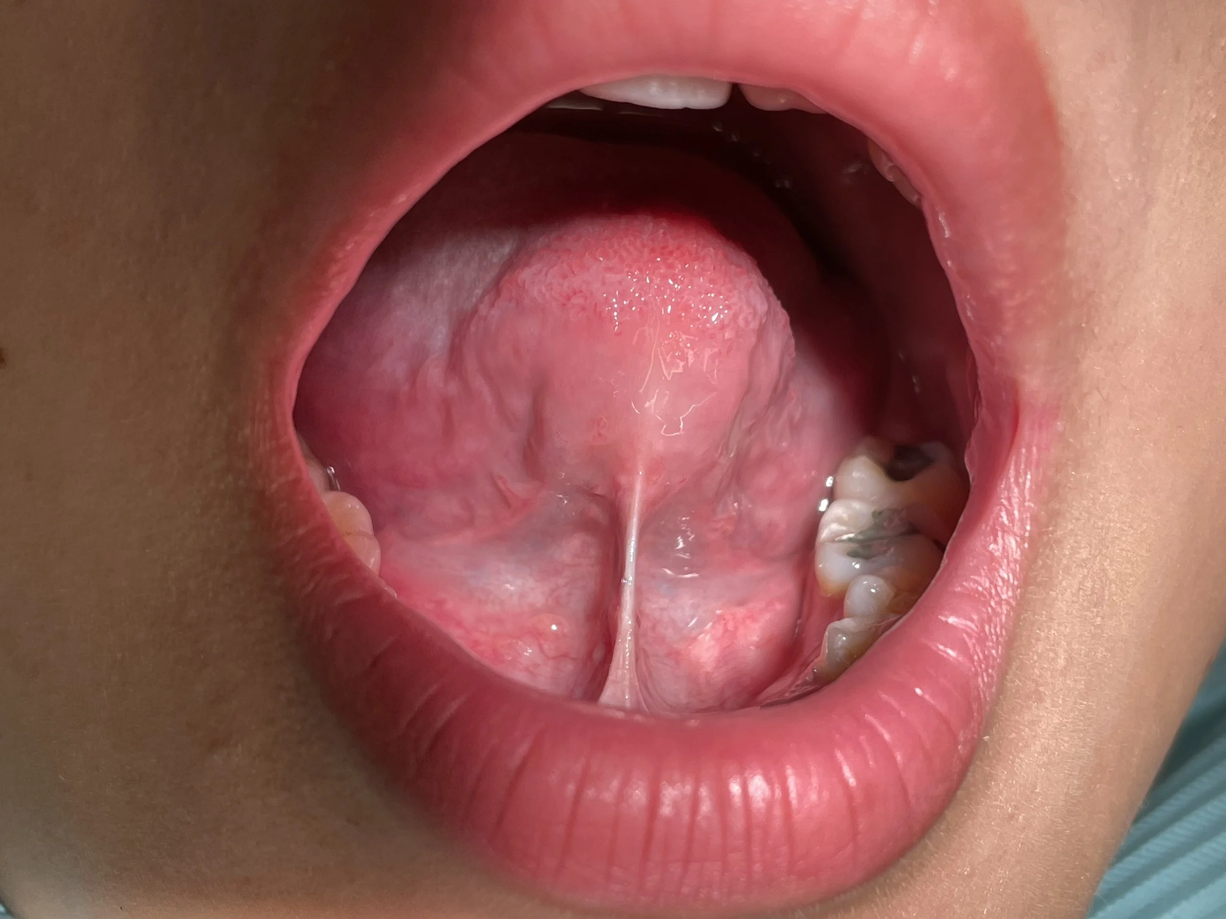 Tongue tie Adult
