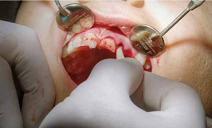 What to Do When Dental Emergencies Strike: A Guide to Handling Common Dental Crises