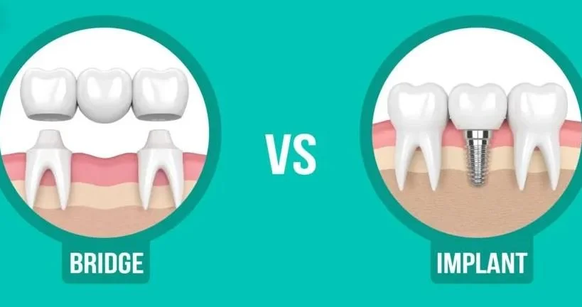 Dental Implants vs. Fixed Bridges: A Comprehensive Guide
