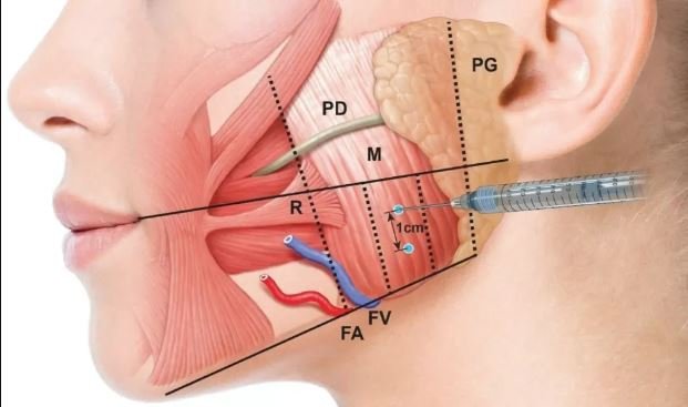 Efficacy of Botox in Managing TMJ Disorder