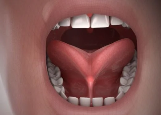 From Speech to Sleep: The Far-Reaching Effects of Adult Tongue Tie