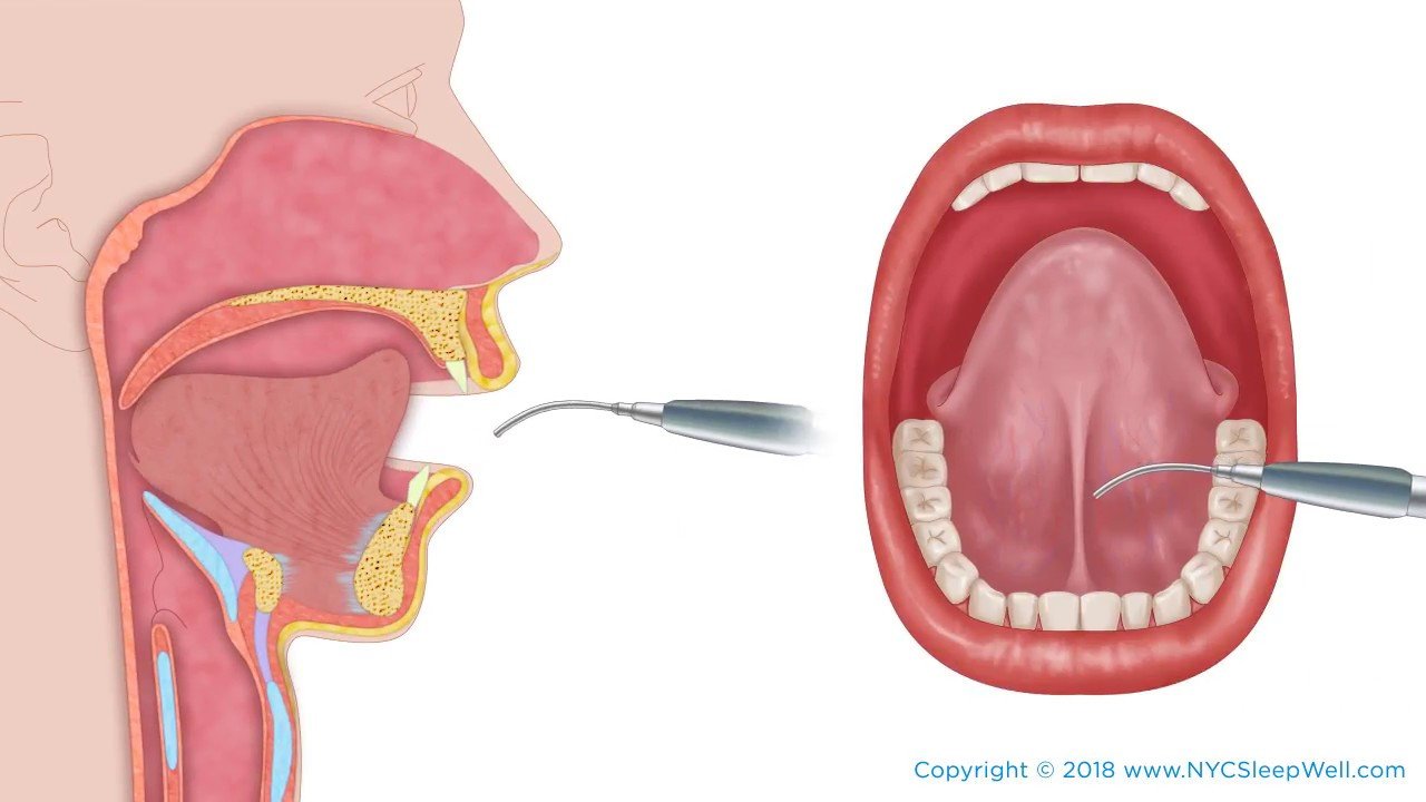 Frenulum Removal Tongue