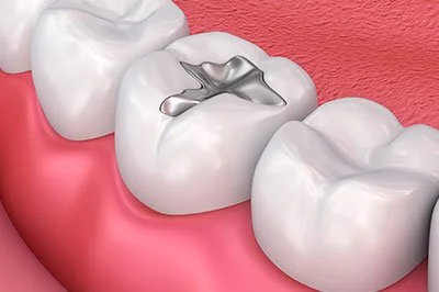 Amalgam Removal: A Holistic Approach to Dental Health