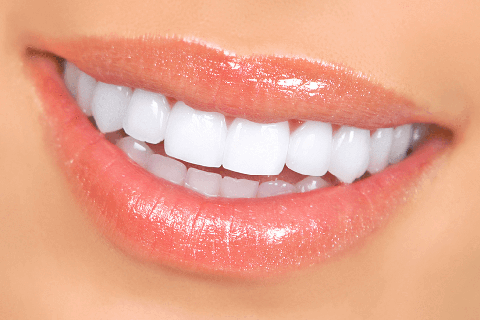Brighten Your Smile: The Ultimate Guide to Teeth Whitening and Veneers —  Pain Free Dentist Sydney