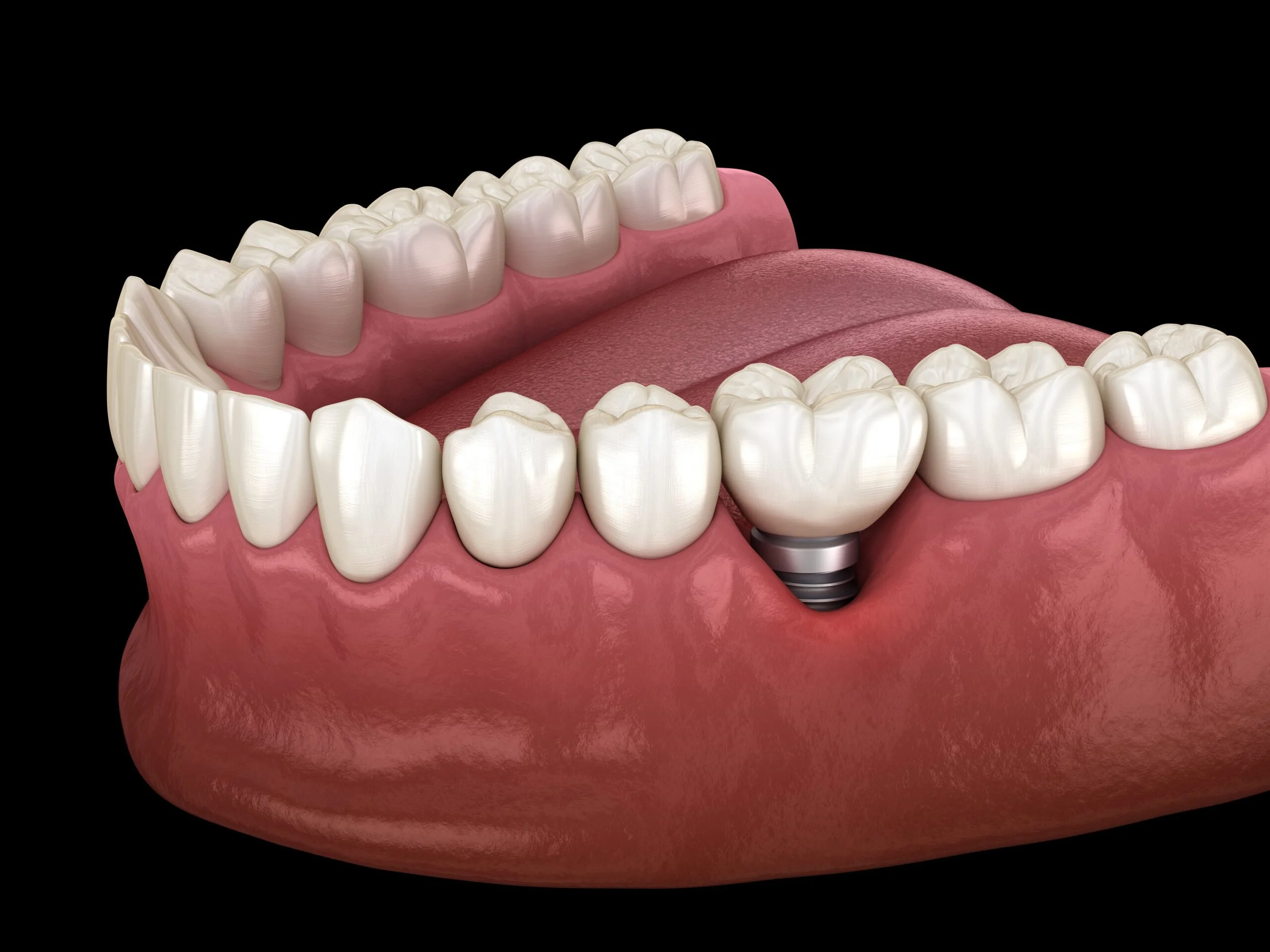Are You a Good Candidate for Dental Implants?