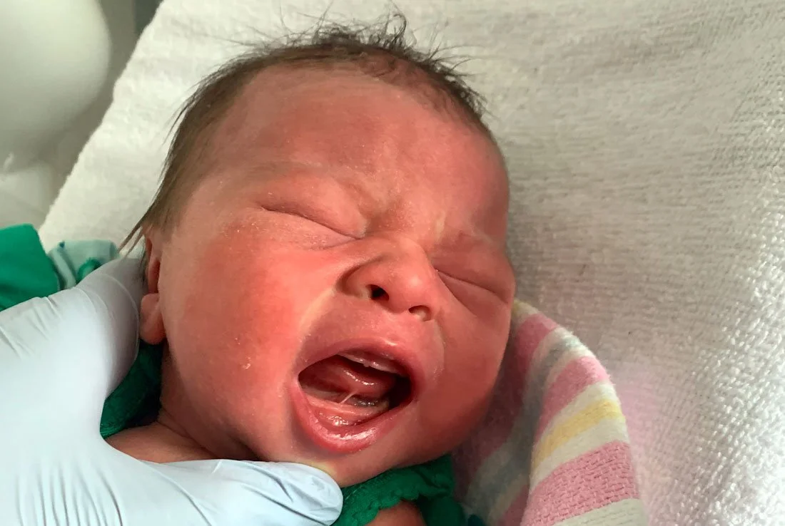 Can Baby Tongue Tie Cause Acid Reflux and Gas? A Guide for Parents