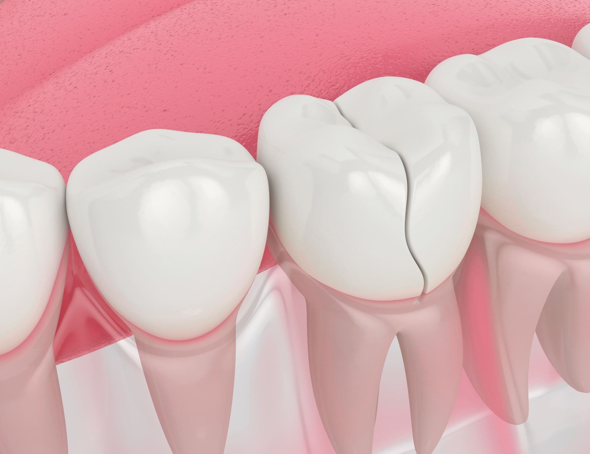 Cracked Teeth: Causes, Symptoms, and Treatment Options