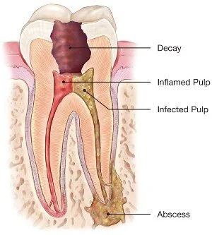 Sensitive to Hot & Cold? You Might Need a Root Canal!
