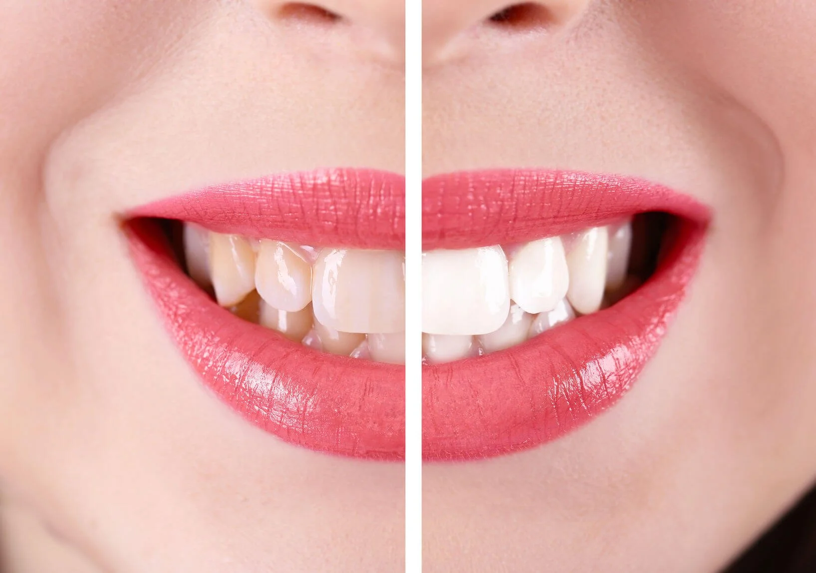 Is Teeth Whitening Safe? Here’s What Dentists Say