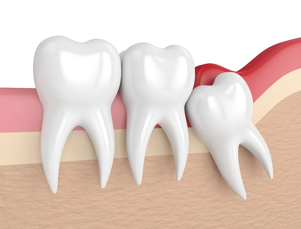 Wisdom Teeth Removal: What to Expect Before, During, and After Extraction