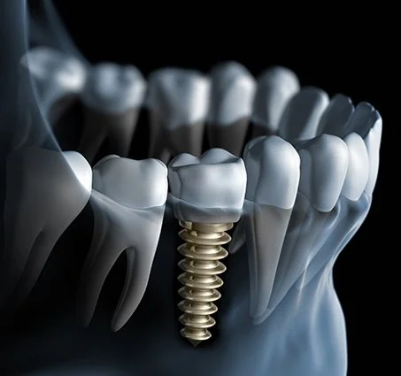 Discover the Benefits of Dental Implants at Pain Free Dentist Sydney