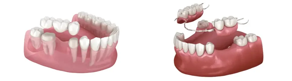 Dentures vs Dental Bridges: Which Tooth Replacement Option Is Right for You?