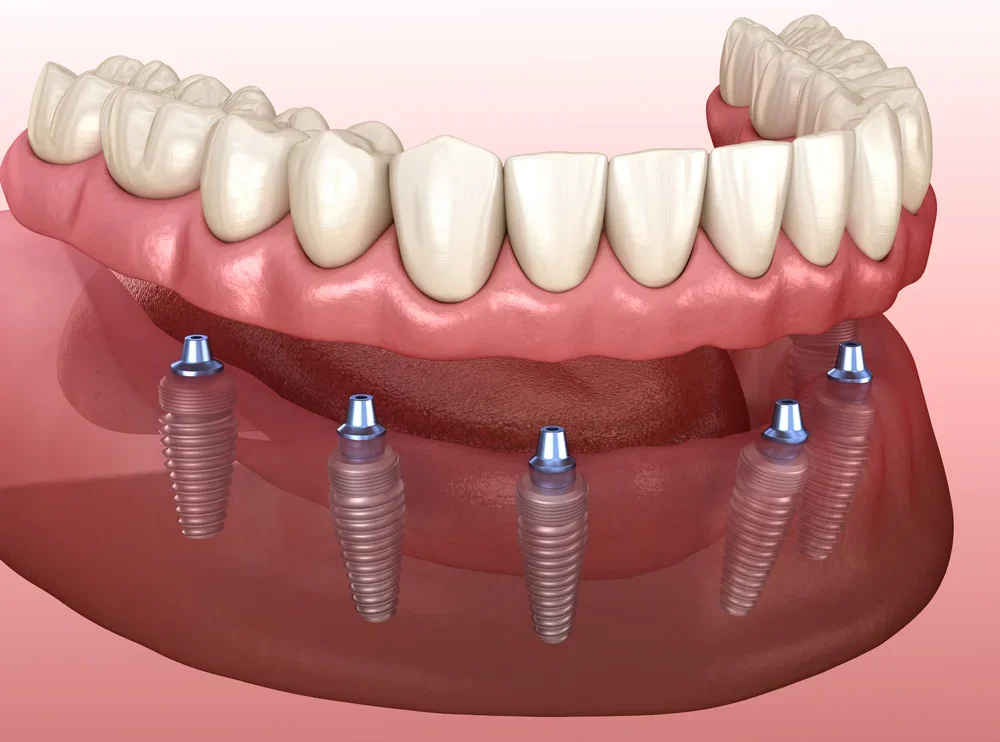 All-on-6 Dental Implants Sydney