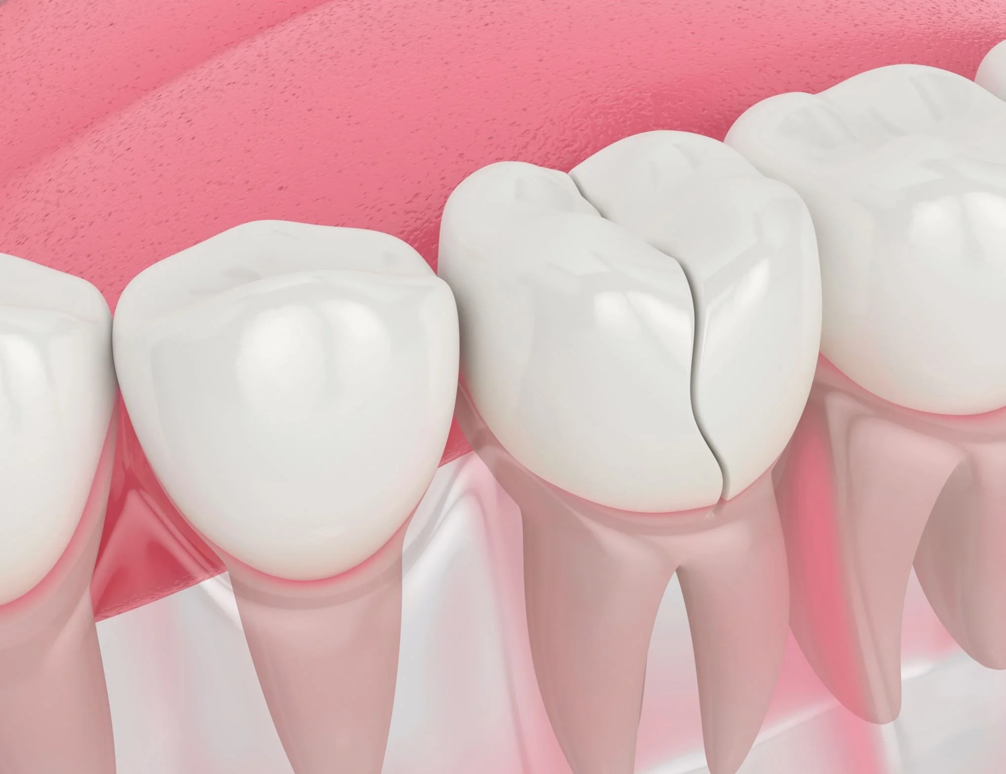Cracked Molars from Teeth Grinding: Causes, Symptoms & Treatments