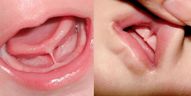 Understanding Baby Tongue Tie: Causes, Symptoms, and Treatment
