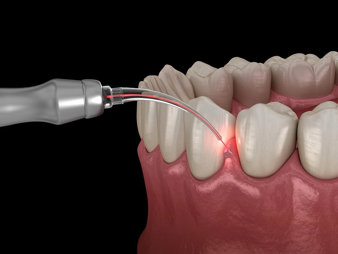 Laser Dentistry for Gum Disease: A Gentle, Effective Solution