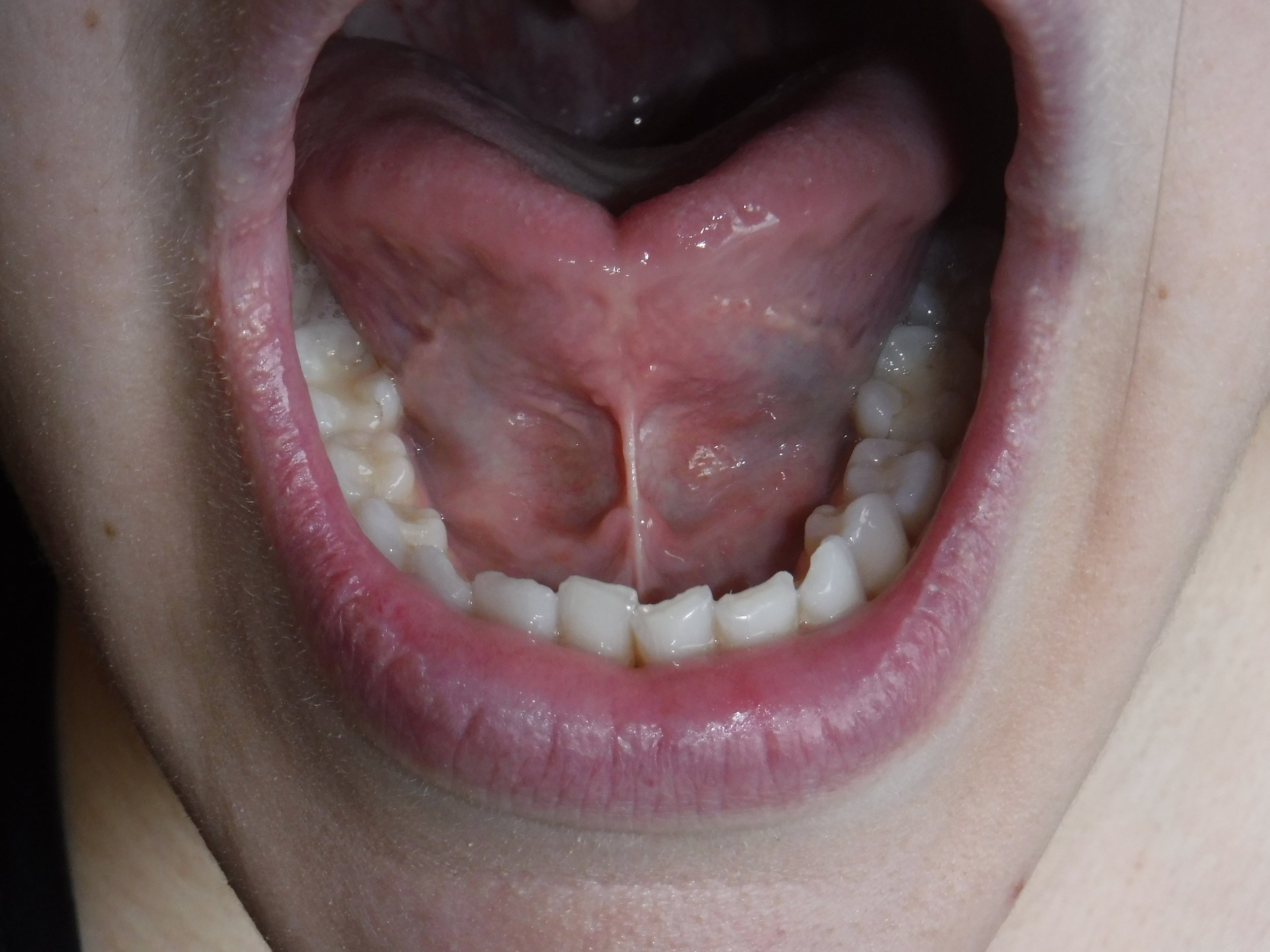 Tongue Tie in Adults: Chronic Pain, Discomfort, and How Treatment Helps