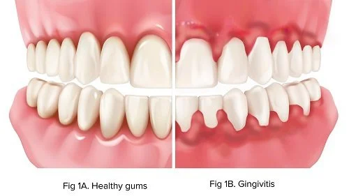 Gum Disease and Holistic Health: More Than Just Your Gums