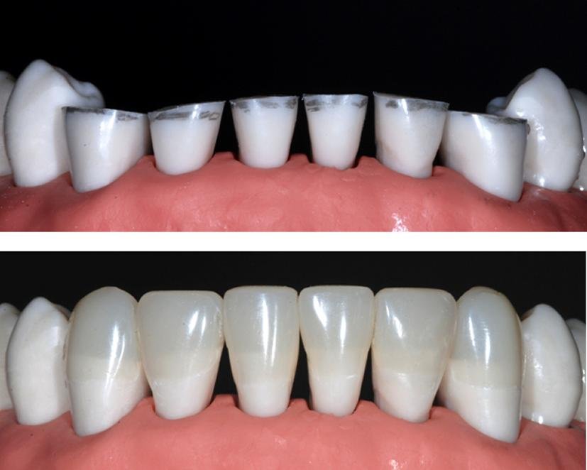 Composite Build-Ups for TMJ Patients: Restoring Function, Comfort, and Smile Aesthetics