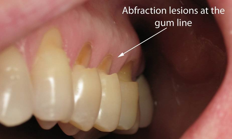 Teeth Grinding and Abfraction: Protecting Your Teeth from Damage