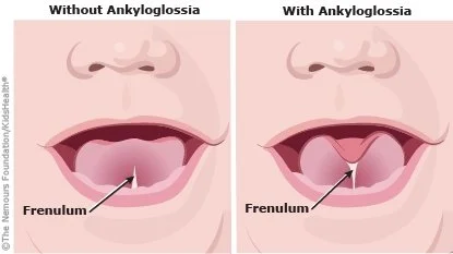 Baby Tongue Tie and Lip Tie: Signs, Treatment, and How It Can Help Feeding