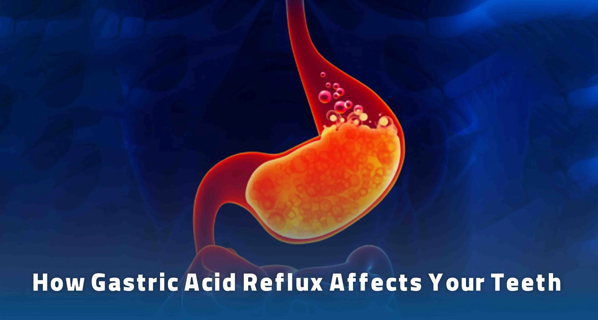 How Acid Reflux Can Impact Your Oral Health