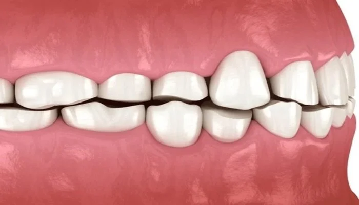 Severe Bruxism and Its Relationship with Chronic Pain