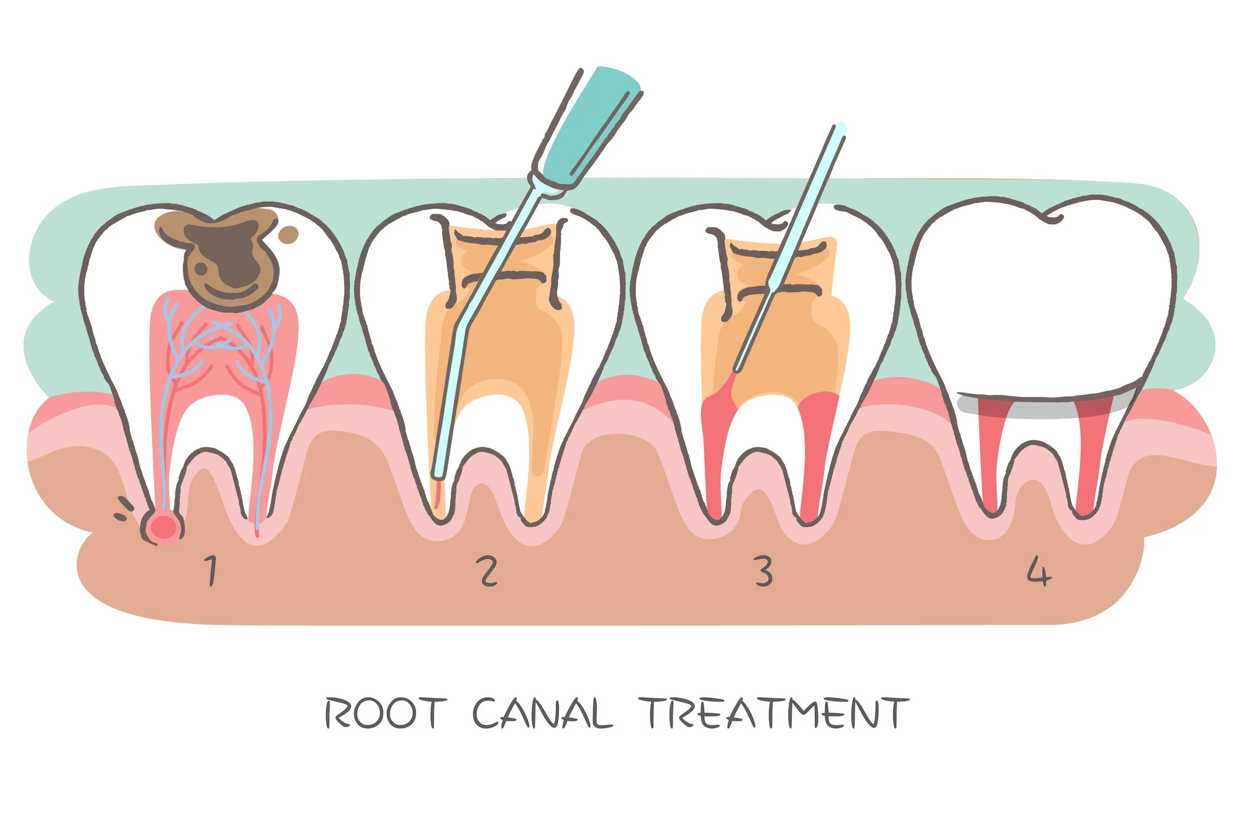 Root Canal Treatment: Benefits and Why It’s Essential for Oral Health