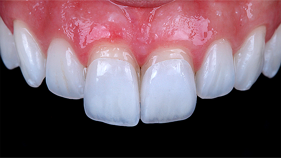 Veneers: Transform Your Smile with Confidence