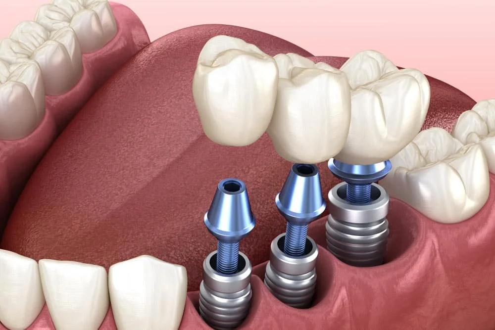 Dental Implants: The Modern, Long‑Lasting Solution for Missing Teeth