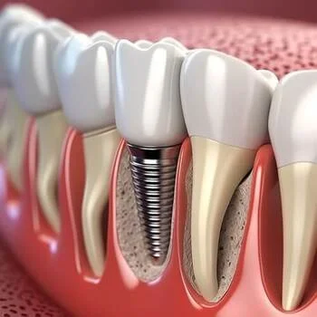 Dental Implants: The Complete Guide for Patients