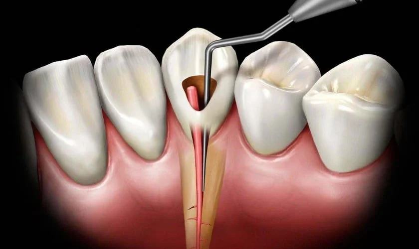 Root Canal Treatment – Save Your Tooth and Relieve Pain