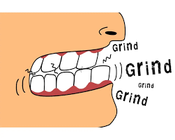 Bruxism: Causes, Symptoms, and Effects on Your Health