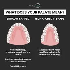 What Your Narrow Palate Says About Your Oral Health