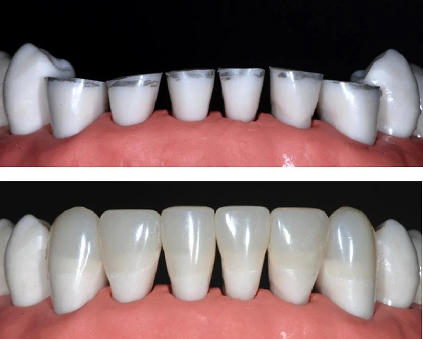 Composite Build-Ups for TMJ Patients: Restoring Function and Comfort
