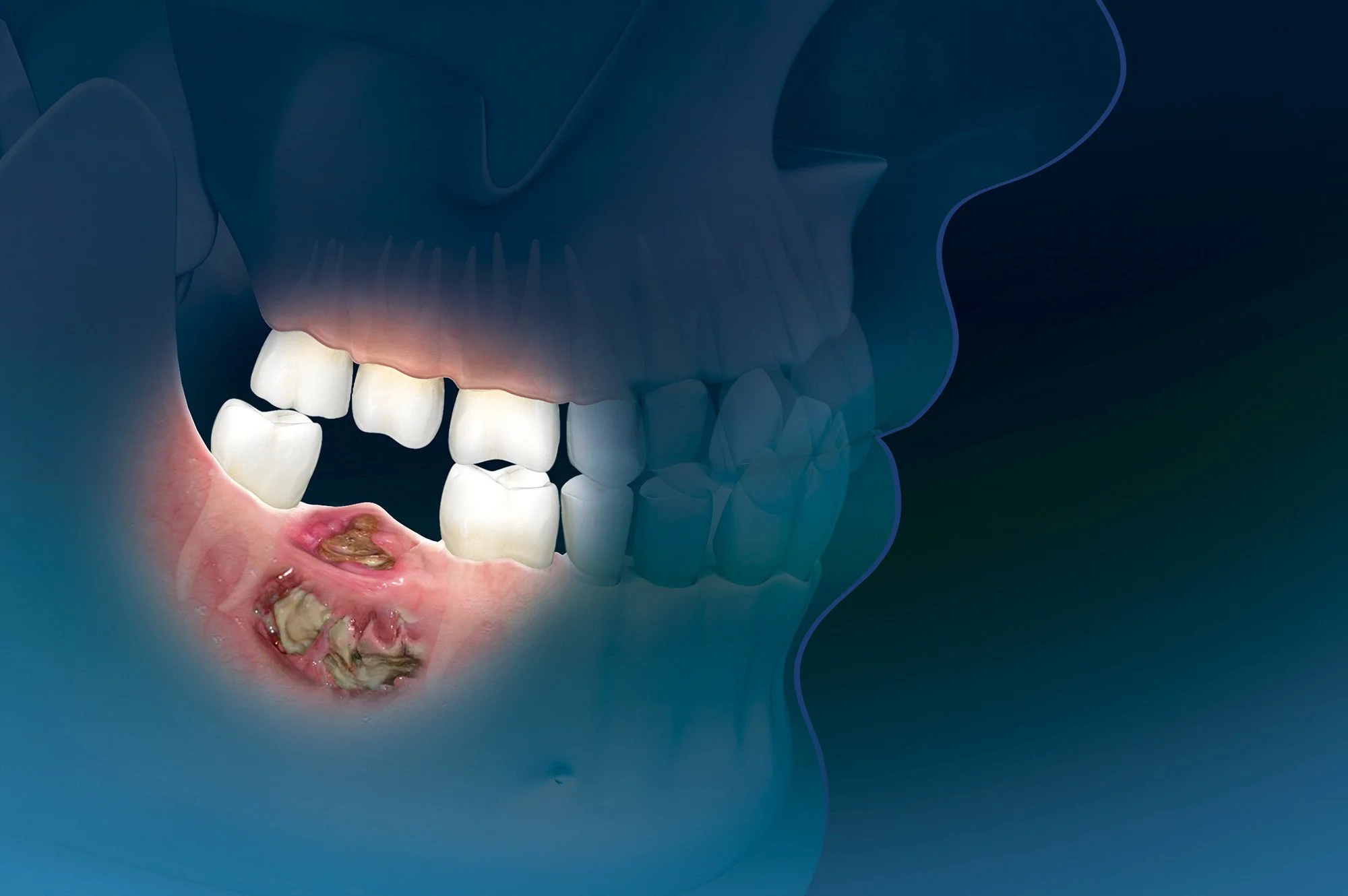 Pre-Bisphosphonate Dental Check: Protect Your Jaw and Smile