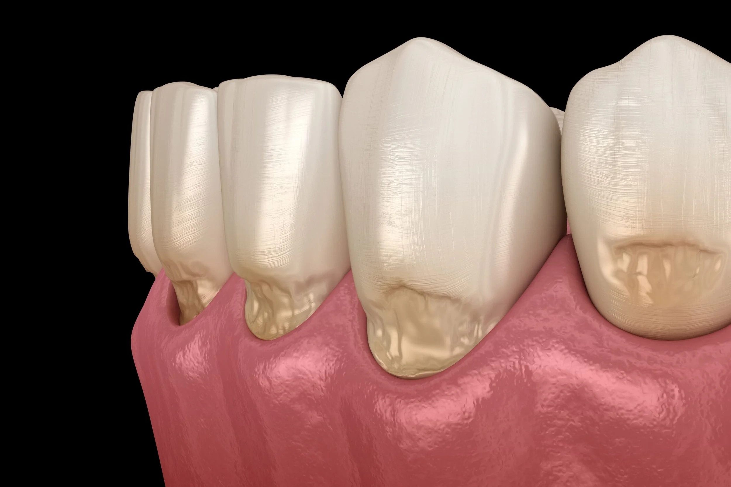 Abfraction from Bruxism: Why Your Teeth May Be Wearing Away at the Gumline