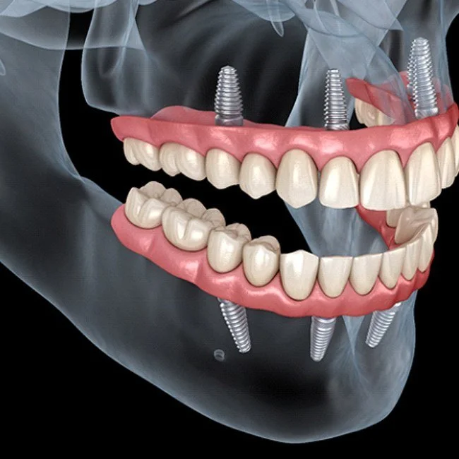 All-on-6 Dental Implants: A Permanent Full-Arch Smile Solution