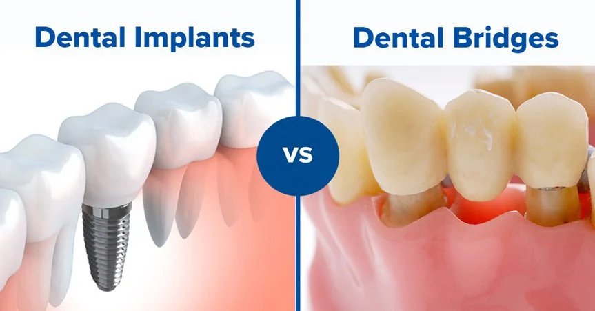 Dental Implants vs Dental Bridge: Which Is the Better Tooth Replacement Option?