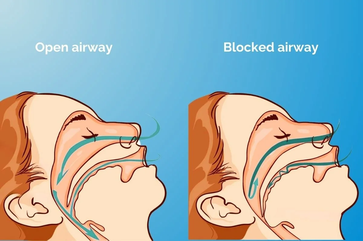 TMJ Disorder, Teeth Grinding, Headaches, Ear Pain &amp; Sleep Apnea: What’s the Connection?