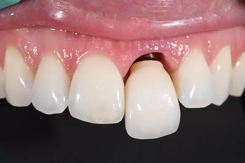 Single Anterior Dental Implant: Why It’s the Best Option for Replacing a Front Tooth