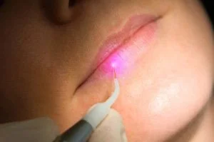 Cold Sore &amp; Aphthous Ulcer Laser Treatment