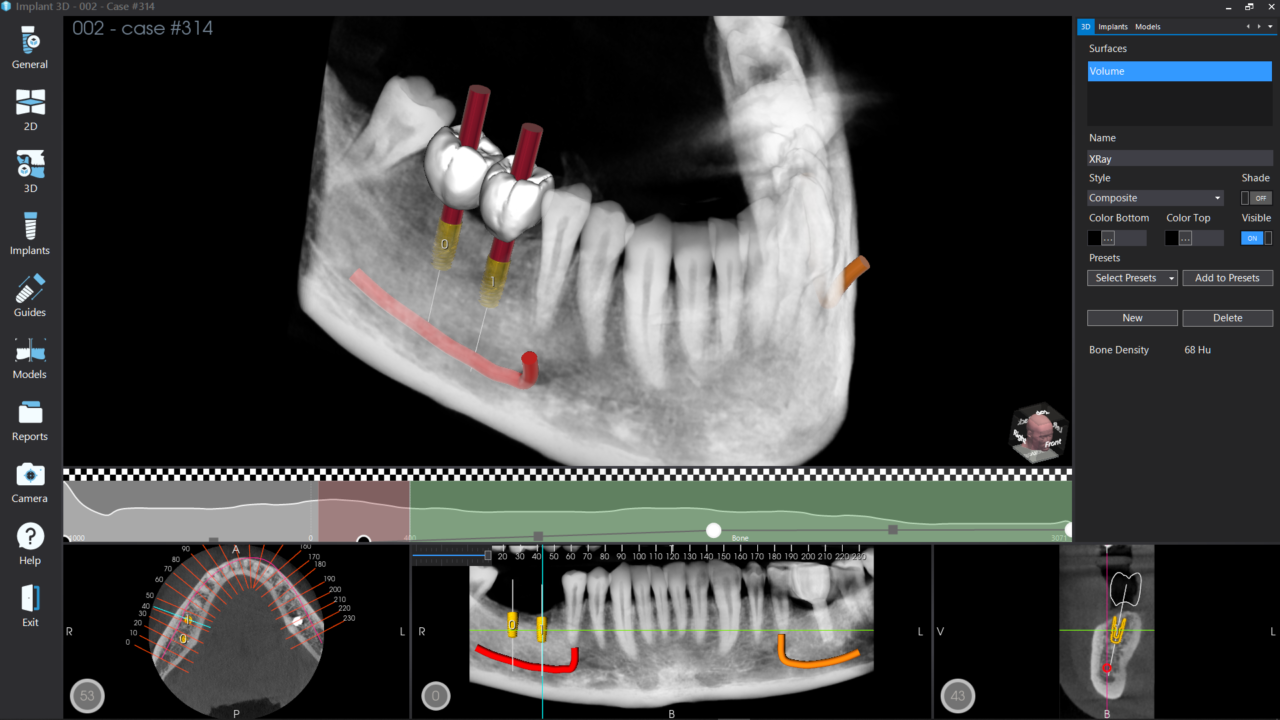 All-on-6 Dental Implants: Benefits, Procedure and Long-Term Results