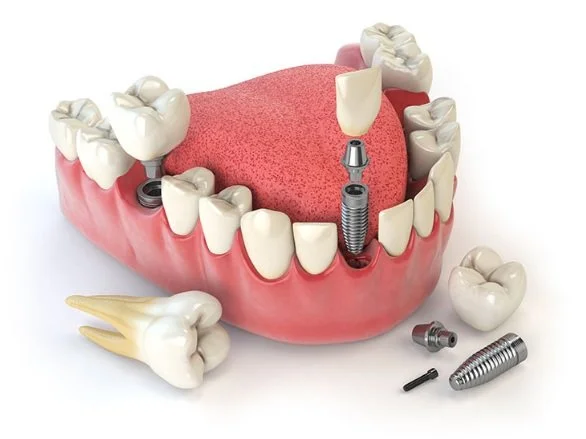 Single Dental Implant vs Dental Bridge: Which Tooth Replacement Option Is Right for You?