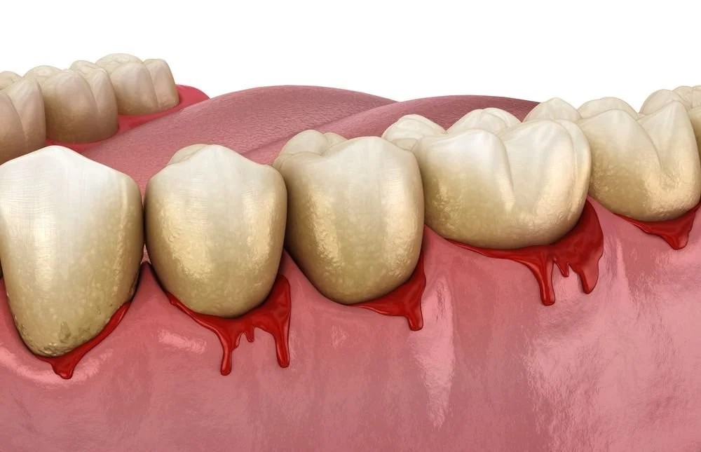 Gum Disease: Causes, Symptoms, Treatment & Prevention