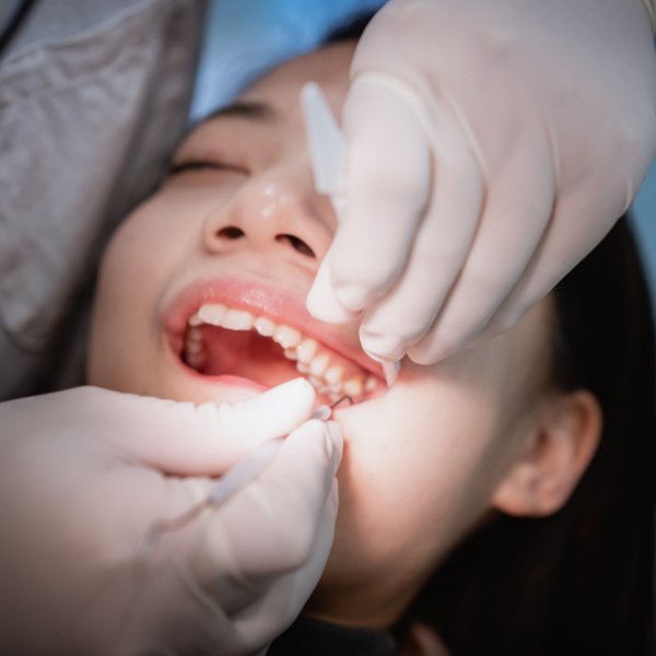 Pain-Free Dentistry in Sydney: Gentle, Anxiety-Focused Care