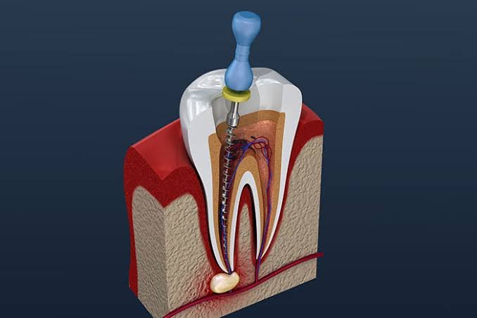 Gentle Endodontic Care: Root Canal Treatment in Hurlstone Park and Surrounding Sydney Areas